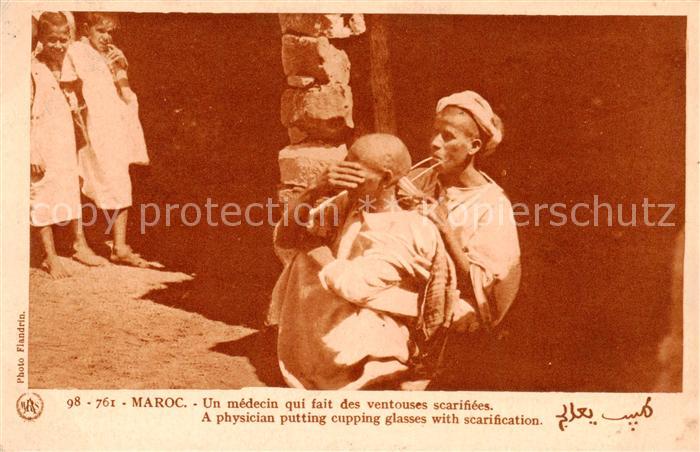Maroc Marokko Un medecin qui fait des ventouses scarifiees